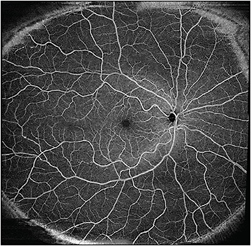 OCT Angiography Example