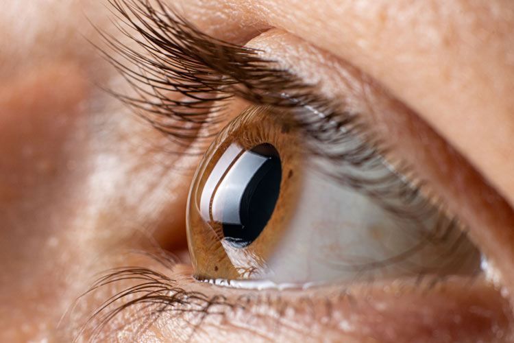 Keratoconus