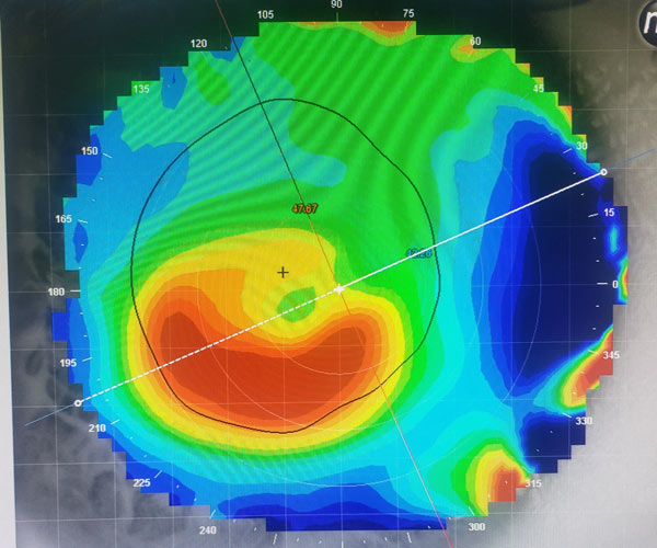 Corneal topography example